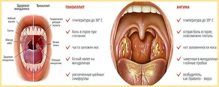 4 Ways to Remove Tonsil Stones (Tonsilloliths) - wikiHow