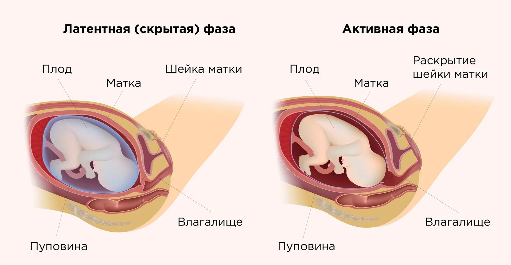 Периоды родов раскрытие шейки матки. Периоды раскрытия шейки.