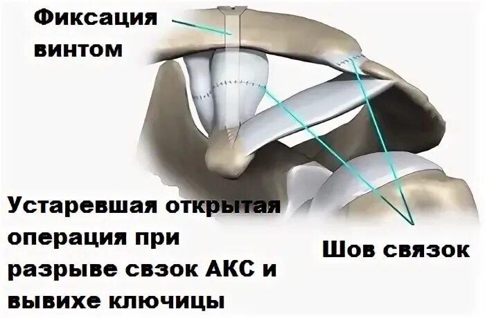 Акс это в медицине