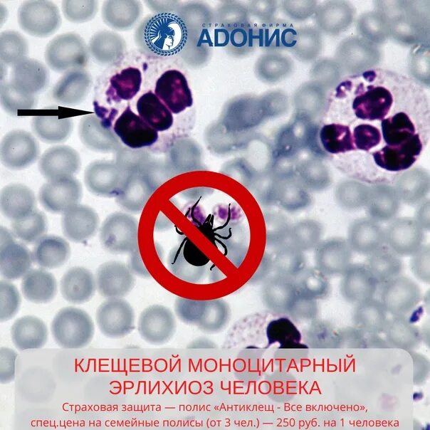 Моноцитарный эрлихиоз человека что это. Моноцитарный эрлихиоз симптомы. эрлихиоз инфекционные болезни. моноцитарный эрлихиоз человека. моноцитарного эрлихиоза человека.
