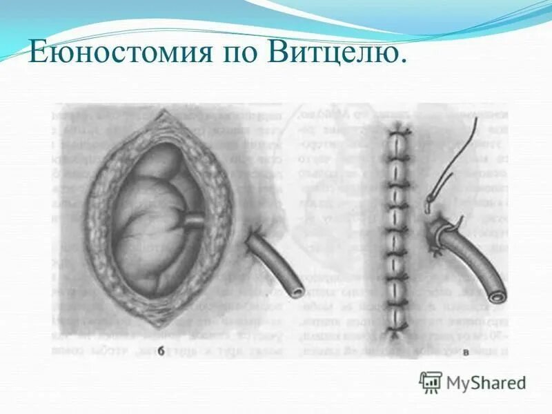 Еюностома это. Еюностома техника операции по витцелю. кисетный шов на прямой кишке. ушивание ран тонкой кишки.