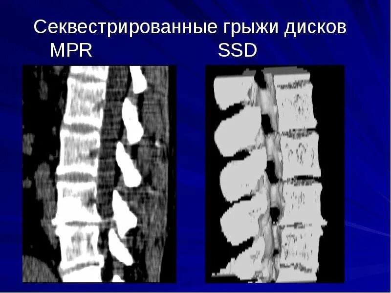 Грыжи на кт