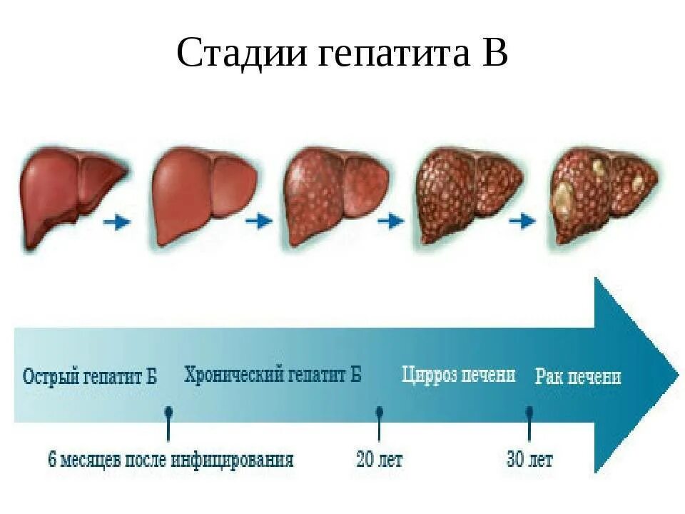 Стадии поражения цирроза печени. Цирроз печени стадии гепатит с. Хронический гепатит б стадии. Цирроз печени при гепатите b.
