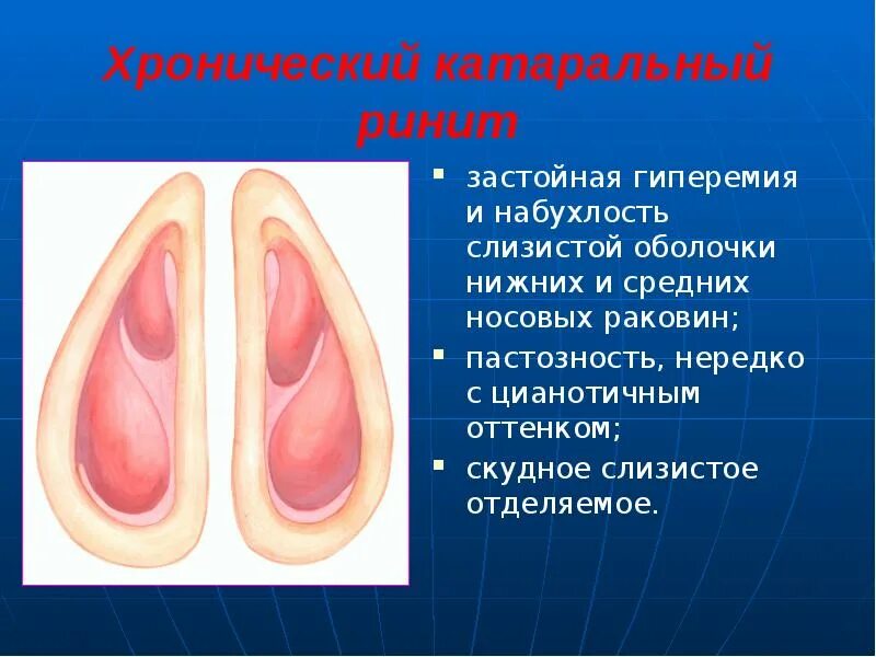 Периоды острого катарального ринита. Хронический гипертрофированный ринит. Хронический катаральный ринит. Гипертрофический ринит виды. Вазомоторный ринит носовые раковины.