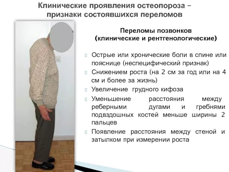 Остеопороз у молодых. Клинические проявления остеопороза. перелом позвоночника при остеопорозе. остеопороз симптомы.