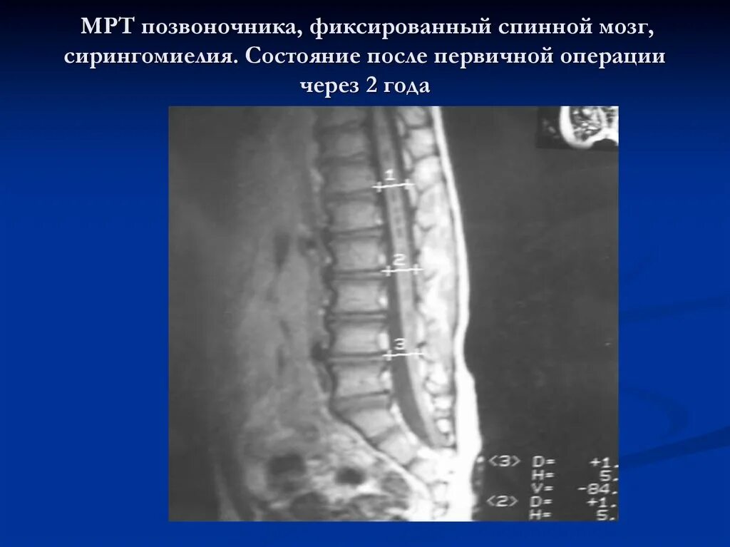Сирингомиелия миелография. Липома терминальной нити мрт. Фиксация спинного мозга. Аномалии развития спинного мозга. Липома терминальной нити синдром фиксированного спинного мозга.
