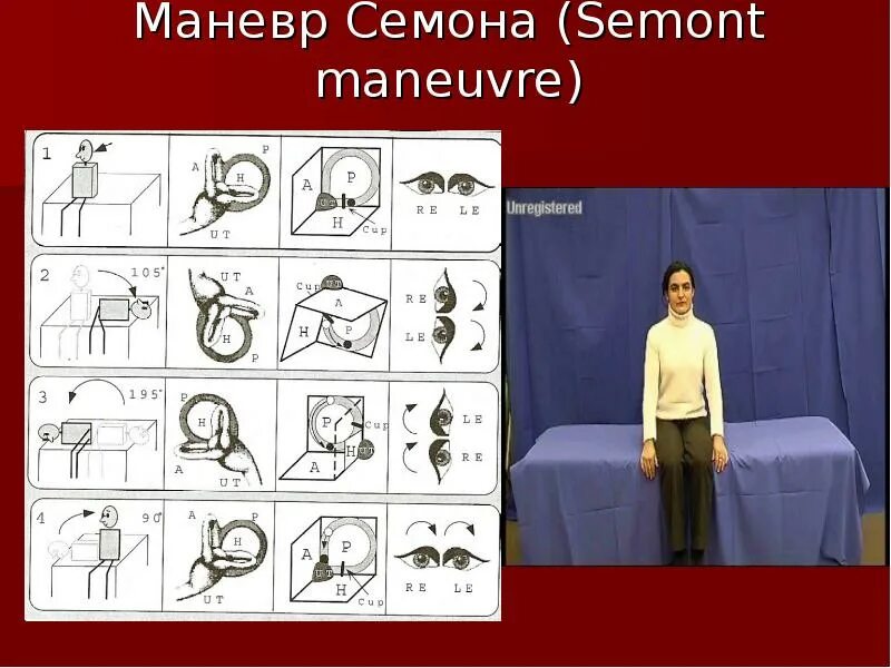 Доброкачественное головокружение упражнения. Дппг упражнения. маневр эпли. вестибулярная гимнастика дппг. доброкачественное позиционное головокружение упражнения.