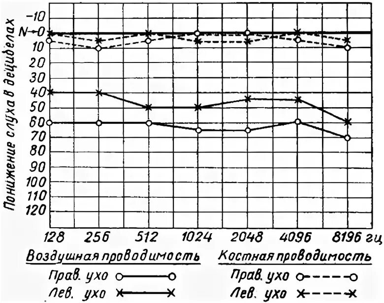 Тональная пороговая аудиометрия методика. Аудиометрия нижний новгород. Слуховой рефлекс импедансометрия. Акустическая импедансометрия тимпанограмма типа в. Аудиометрия нижний новгород.
