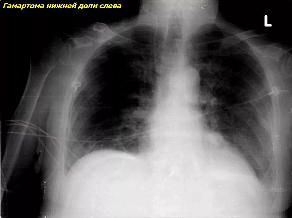 Гамартома нижней доли левого легкого. Доброкачественные образования легких. Доброкачественная опухоль легкого. Доброкачественные опухоли легких. Образование в легких что это может быть