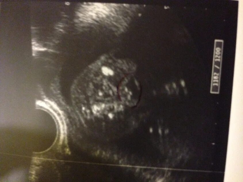 узи 19 недель девочка. 19 неделя узи неделя беременности. узи 19 недель девочка. узи 19 недель беременности мальчик. узи девочка на 18-19 неделе беременности.