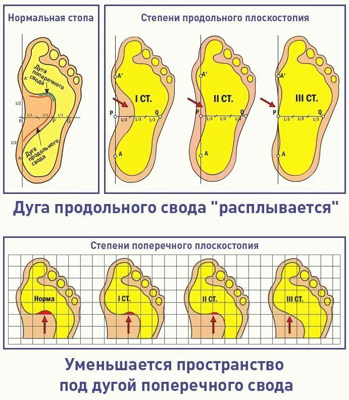Правильные стопы ног. Поперечное плоскостопие третьей степени. продольное вальгусное плоскостопие. поперечное и комбинированное плоскостопие 1--2 степени. степени продольного плоскостопия таблица.