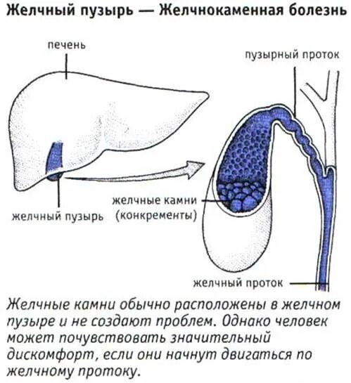 Камень в протоке желчного пузыря что делать. Патологии желчного пузыря. жёлчный пузырь симптомы. изогнутый желчный пузырь. симптомы болезни желчного пузыря.
