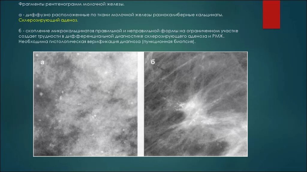 Кистозная мастопатия маммография. Склерозирующий аденоз молочной железы маммография. Аденоз молочной железы рентген. Фиброаденоматоз bi