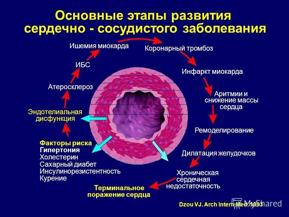 Центр диабета и сосудистой патологии. Стадии развития сердечно сосудистых заболеваний. сердечно-сосудистый континуум атеросклероз. атеросклероз эндотелиальная дисфункция. основные стадии развития сердечно-сосудистой системы.