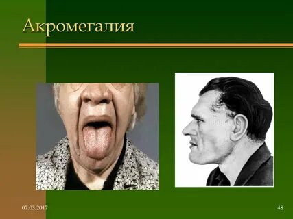 Акромегалия