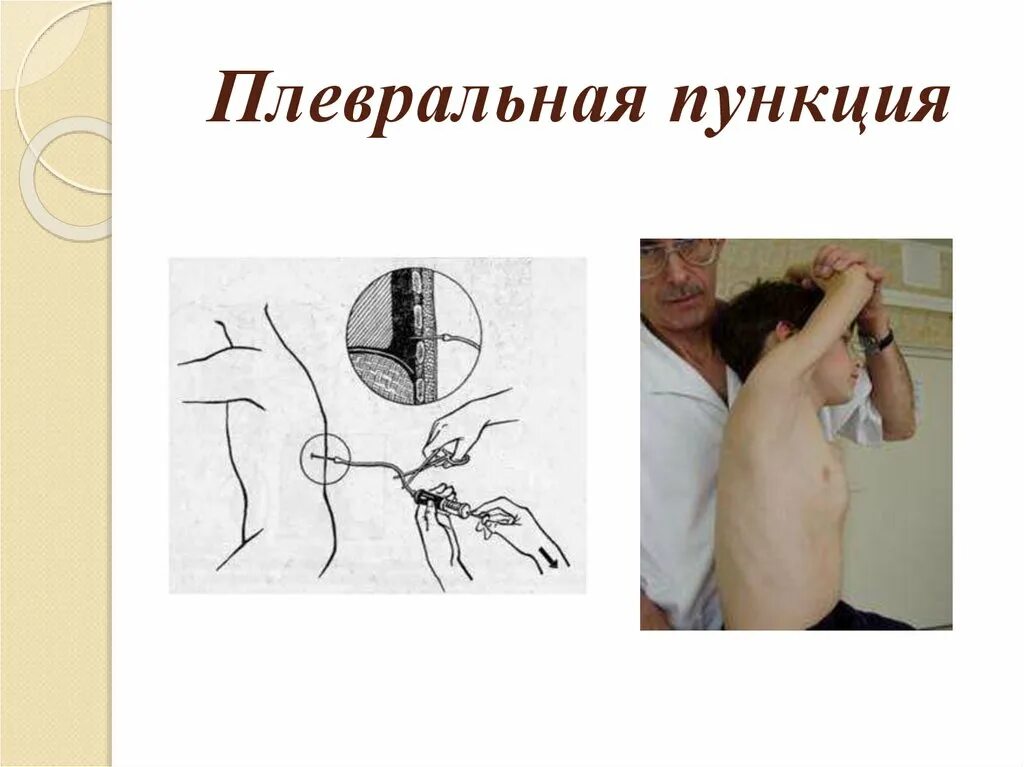 Техника выполнения плевральной пункции. Пункция грудной клетки. Лекция пункции Сестринское дело. Пункция из грудной клетки.