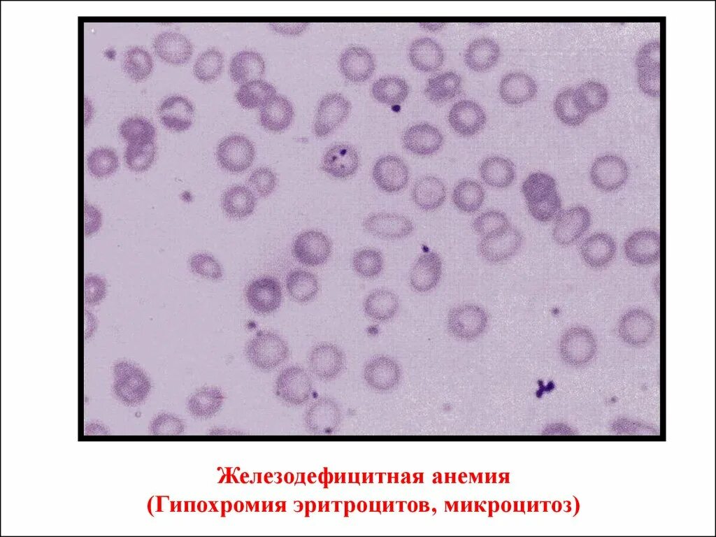Гипохромия железодефицитная анемия. Гипохромная анемия картина крови. Микроцитарная гипохромная анемия микроскоп. Анемия гипохромия микроцитоз. Гипохромная анемия мазок крови.