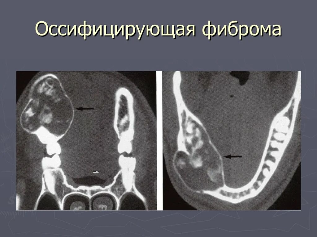 Фиброма кт. Оссифицирующая фиброма кт. одонтогенная фиброма нижней челюсти кт. оссифицирующая фиброма бедренной кости кт.