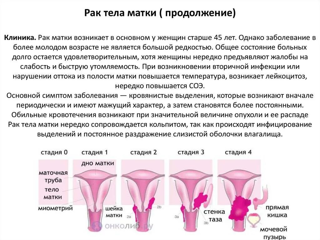 Как распознать рак матки. Опухоль матки симптомы на ранней стадии. ранние симптомы онкологии шейки матки. опухоль шейки матки симптомы на ранней стадии. новообразование в матке.