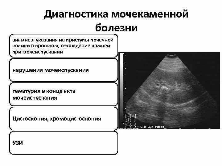 Почечная колика при беременности. Методы обследования при мочекаменной болезни. Инструментальные методы диагностики мочекаменной болезни. Инструментальный метод исследования мочекаменной болезни. Мочекаменная болезнь методы обследования.