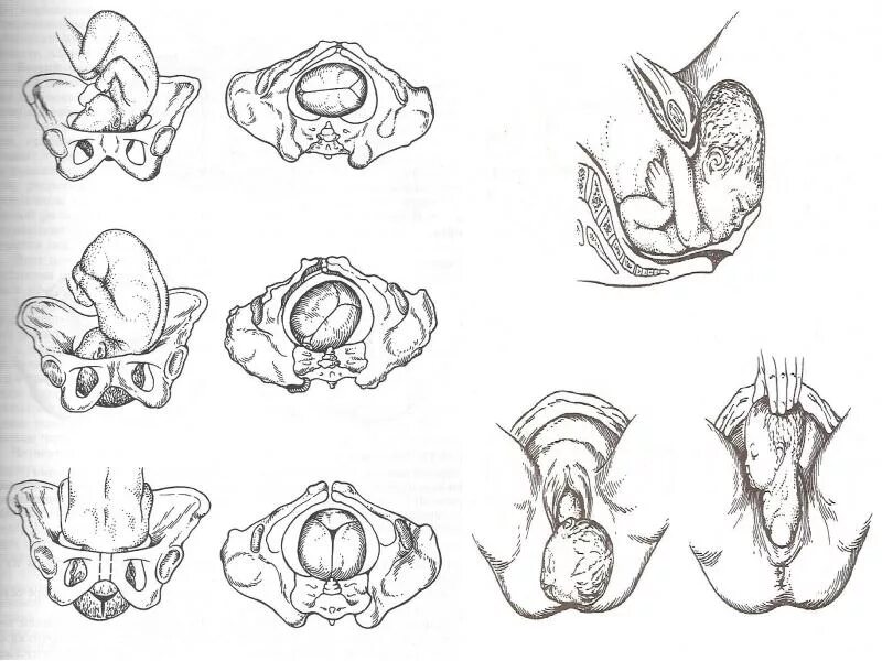 Затылочное предлежание плода биомеханизм родов. Биомеханизм родов при переднем виде затылочного предлежания. Биомеханизм родов физиологические роды. Биомеханизм родов переднем виде затылочного.