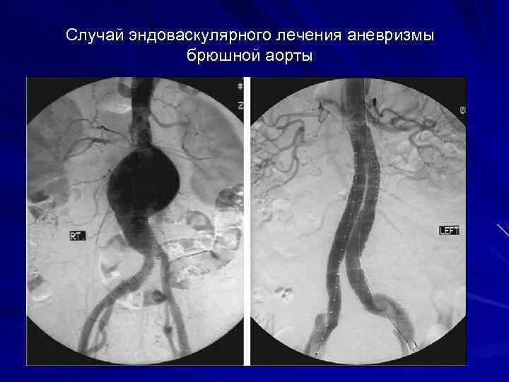 Аорта брюшной полости операция. Аневризма инфраренального отдела. Инфраренальная аневризма брюшного отдела аорты. Юкстаренальная аневризма. Оперирование аневризмы брюшной аорты.