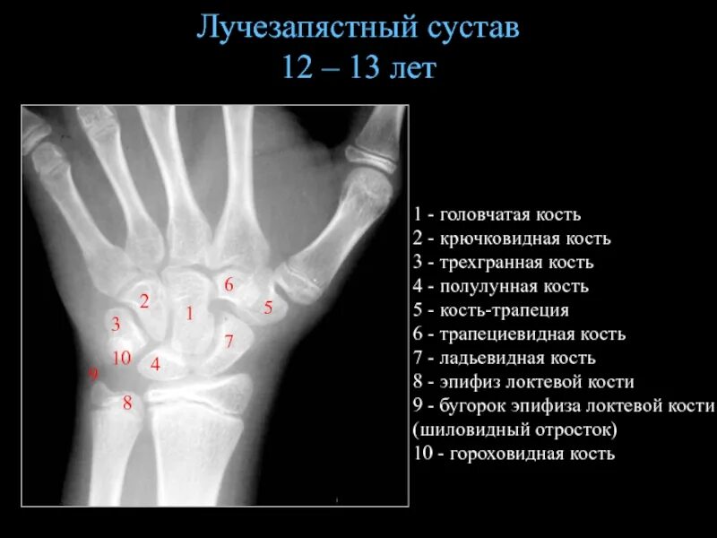 Шиловидный отросток лучезапястного сустава. Лучезапястный сустав рентген анатомия рентгеноанатомия. Шиловидный отросток лучевой кости кисти. Кости кисти руки человека анатомия рентген. Болят лучевые кости почему