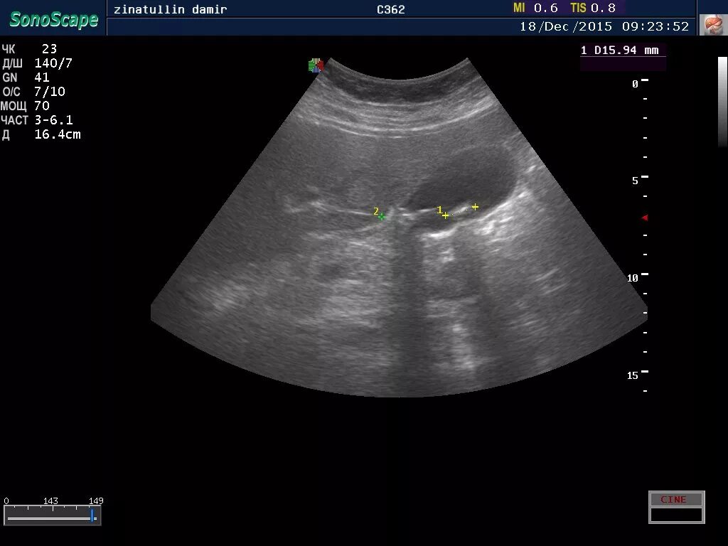 Конкременты желчного пузыря что это такое. Загиб желчного пузыря у ребенка на УЗИ. Конкремент в шейке желчного пузыря на УЗИ. УЗИ желчного пузыря конкременты 1.7 мм. Изгиб шейки желчного
