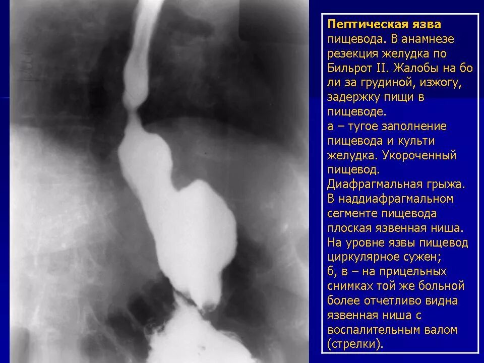 Рентген с барием пищевода и желудка подготовка. Пептическая язва пищевода рентген. Язвенная болезнь 12 перстной кишки рентген. Пептический стеноз пищевода.