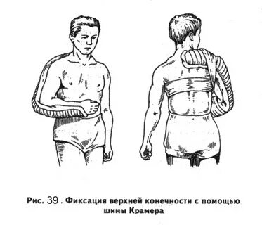 Иммобилизация при вывихе