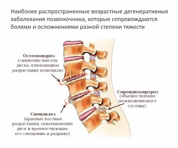 Самые распространенные заболевания позвоночника. Деформирующий спондилоартроз грудного отдела 2 степени. Спондилез 2 степени поясничного отдела позвоночника. Начальный спондилез