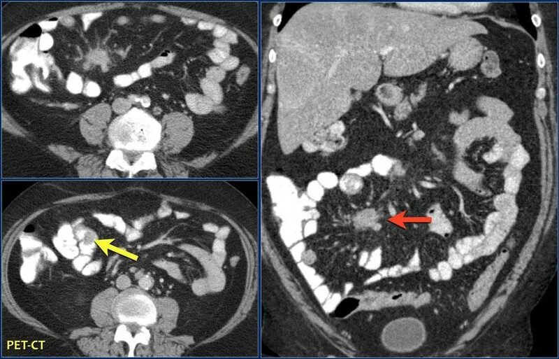 Что такое абдоминальная онкология. Карциноид тонкой кишки кт. Лимфангиома брыжейки кт.