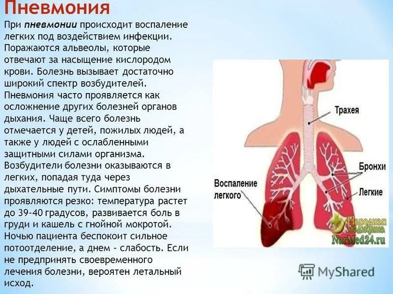 Двухсторонняя пневмония. Заболевания органов дыхания пневмония.