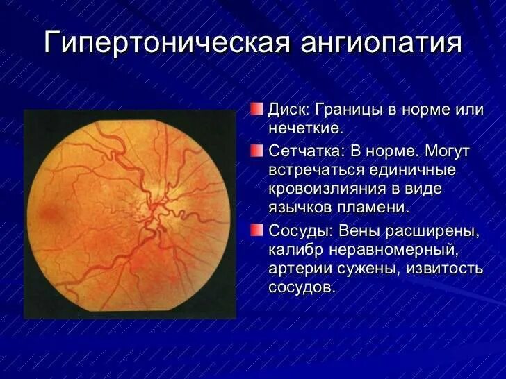Ангиопатия глаз что это такое у взрослых