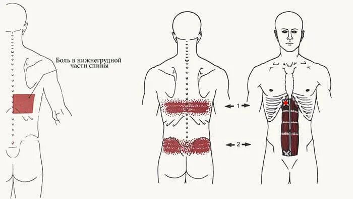 Точки на пояснице. Тт1 триггерная точка. Триггерные точки зубчатой мышцы. Триггерные точки боль мышцы спины. Задняя зубчатая мышца триггерные точки.