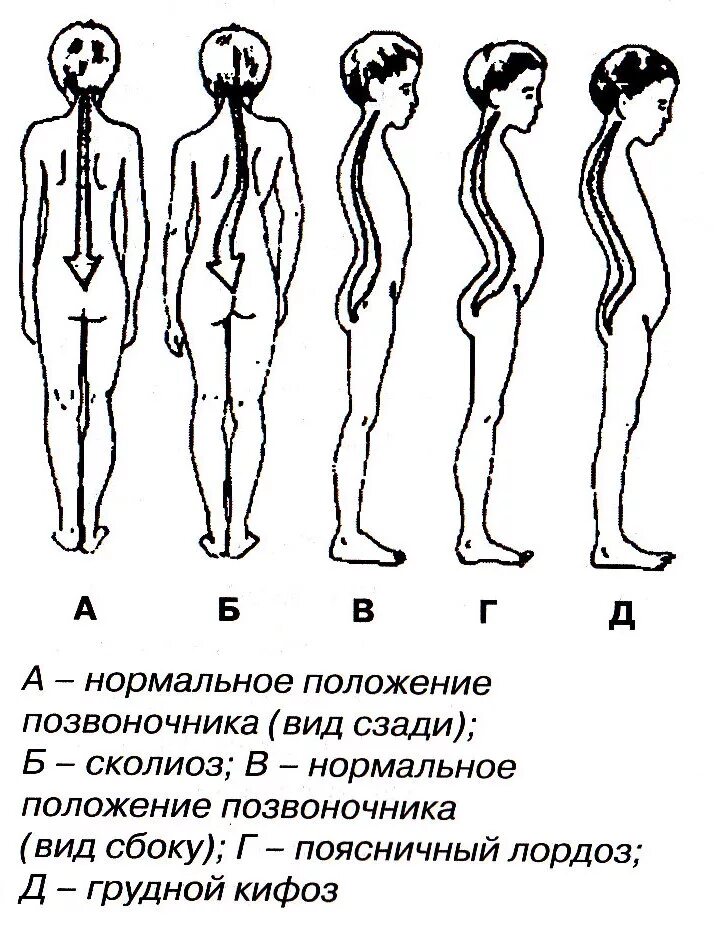 Нормальная поясница. Искривление позвоночника лордоз. Искривление позвоночника лордоз кифоз сколиоз. Типы нарушения осанки кифоз лордоз.