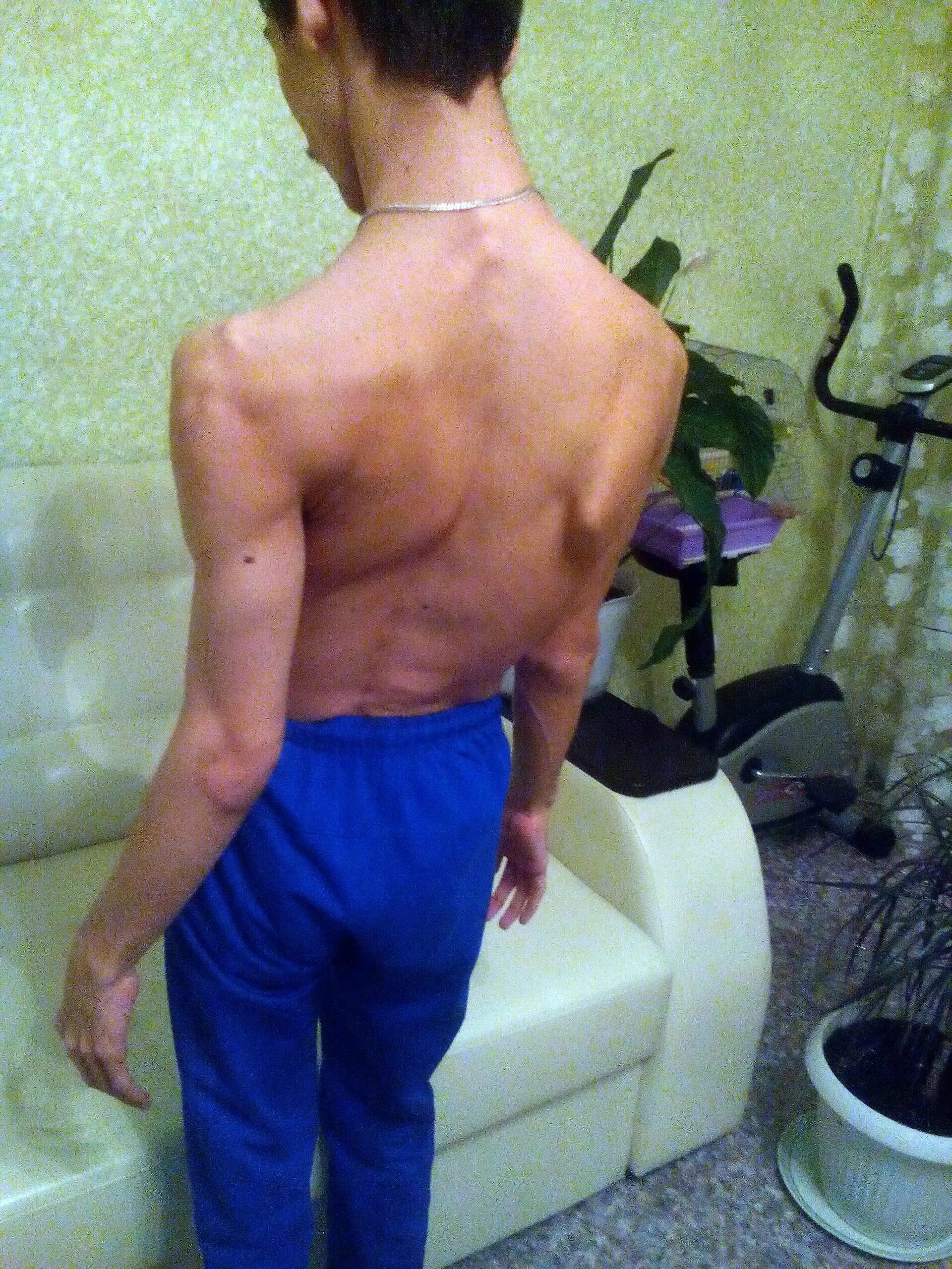 Накаченная спина при сколиозе. Тутора турбокаст для дцп. Дцп сколиоз. Корсет шено дцп. Дцп сколиоз.