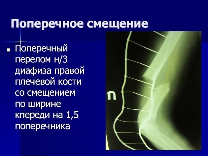 Поперечный перелом диафиза плечевой кости. Смещение кпереди. Смещение голени кпереди. Поперечное смещение.