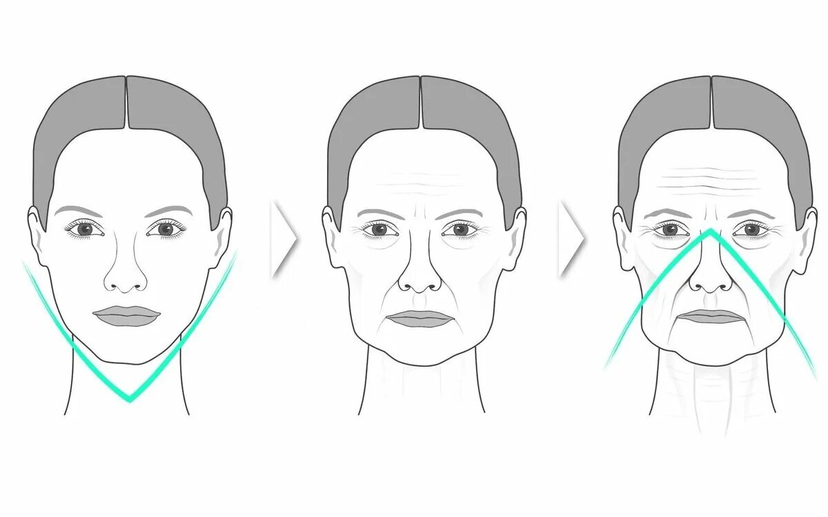 Гравитационный птоз Тип старения. Старение средней трети лица. Старение схема. Птоз лица.