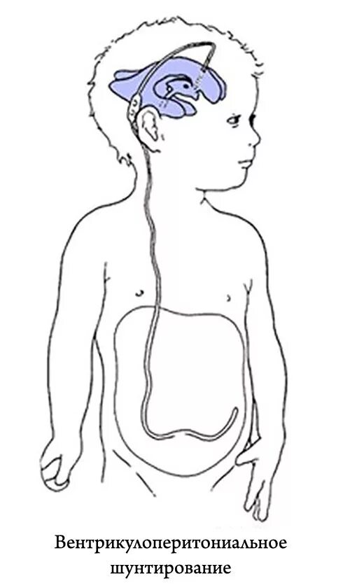 Церебральная ишемия у новорожденного 2. Шунт гидроцефалии схема. ВПШ вентрикулоперитонеальное шунтирование. Вентрикулоперитонеальный шунт схема. Шунтирование гидроцефалии головного.