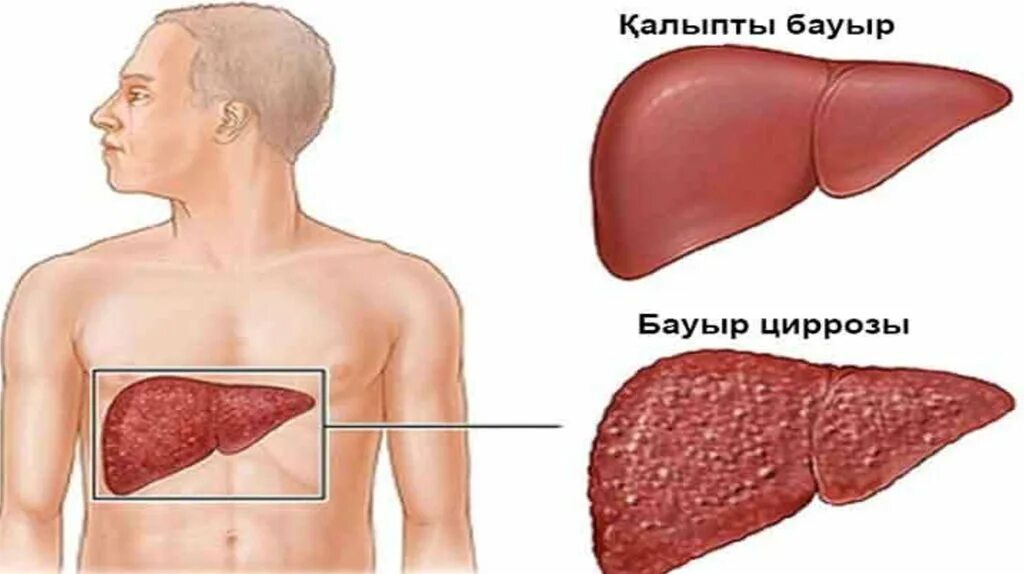 Увеличена печень форум