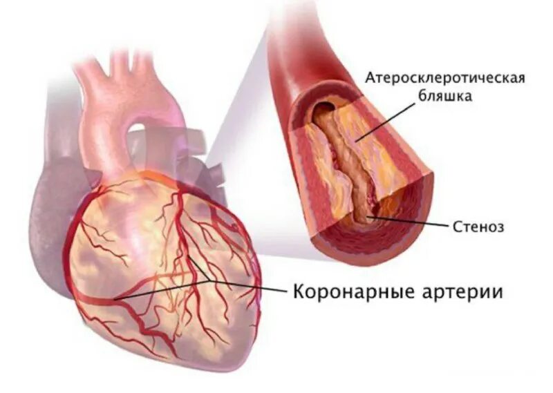 Атеросклеротический стеноз артерий. Атеросклеротическое сужение коронарных сосудов. атеросклеротическое поражение коронарных сосудов. атеросклеротическое поражение коронарных артерий сердца. атеросклероз венечных артерий сердца.
