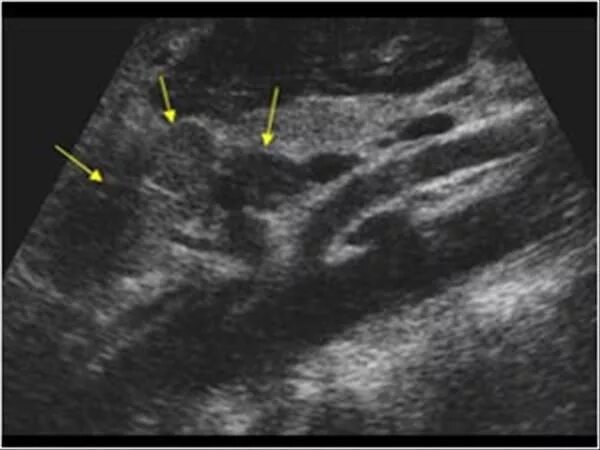 Парааортальные лимфоузлы на УЗИ. Лимфаденит УЗИ лимфоузлов. Забрюшинные лимфоузлы на УЗИ. Парааортальные лимфатические узлы на УЗИ. Лимфаденопатия ворот печени