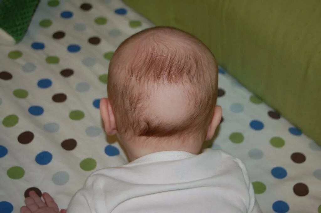 Фосфоропенический рахит. Рахит у детей облысение затылка. Облысение затылка у детей. Облысение затылка у детей. Рахит облысения.