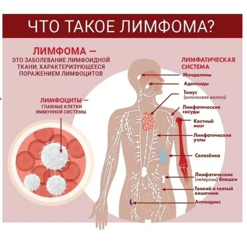 Причина заболевания лимфомой. Всемирный день борьбы с лимфомами. День борьбы против лимфомы. С днем заболевания.