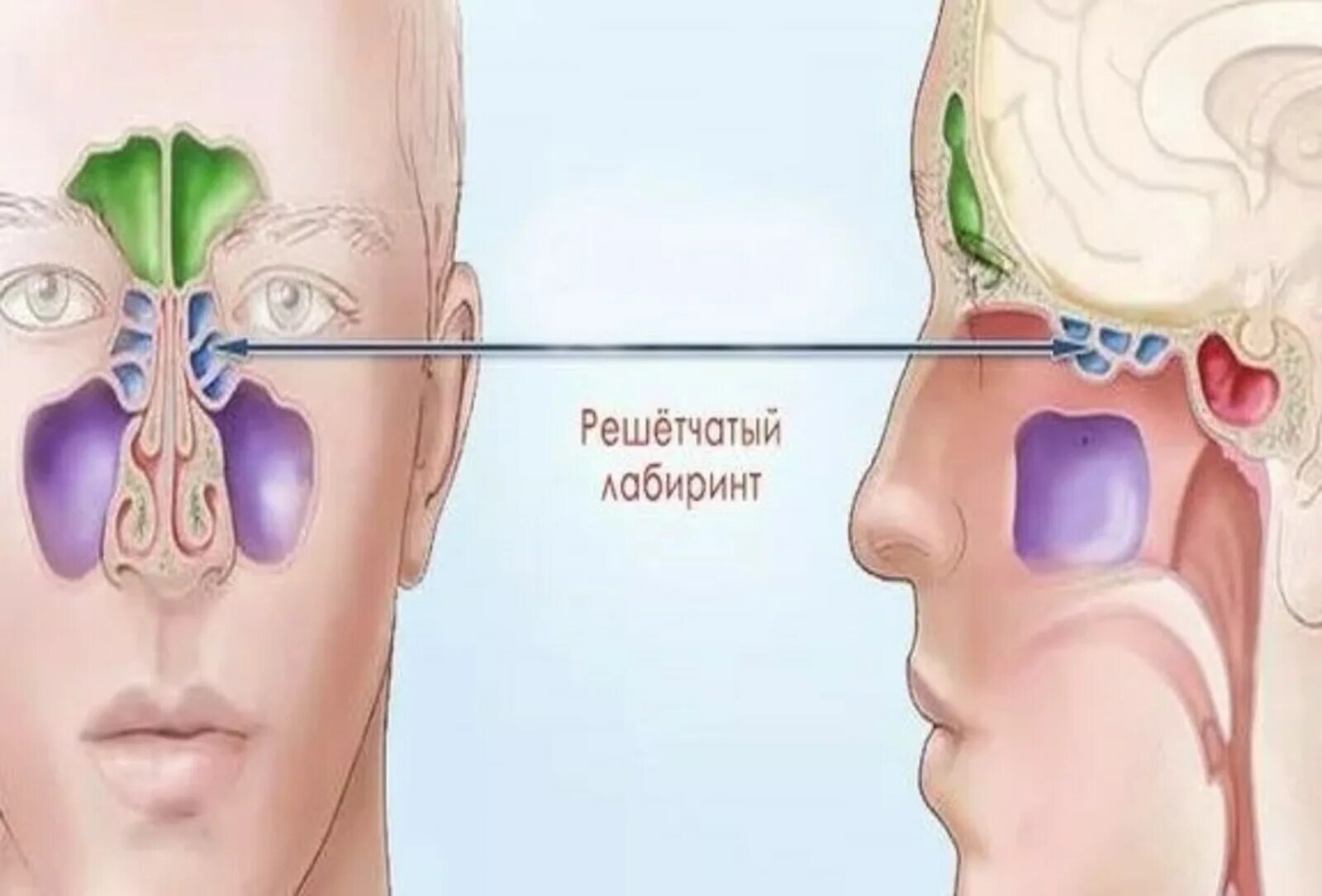 Острый этмоидит-синусит. Пазухи решетчатой кости воспаление. Утолщение слизистой оболочки решетчатых лабиринтов