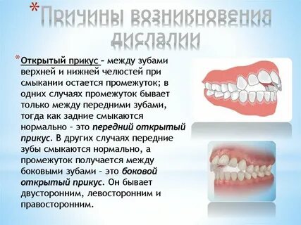 Открытый прикус это