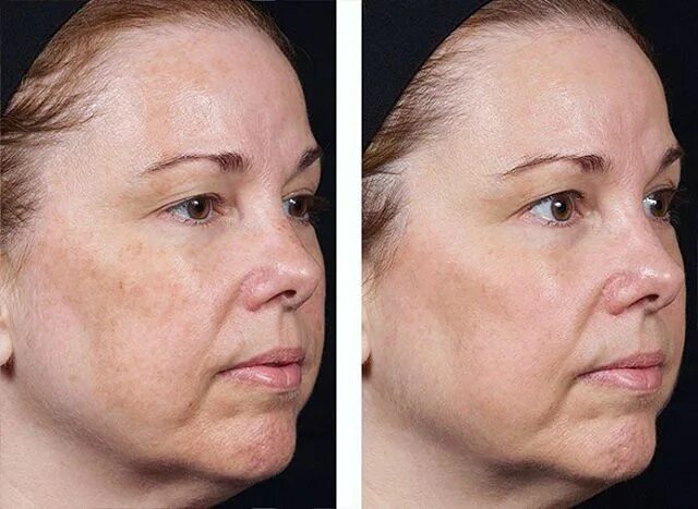 Лазерное омоложение до и после астрея. Фракционный неаблятивный фототермолиз. лазерное омоложение clear brilliant. лазерная шлифовка clear brilliant. clear brilliant лазер процедура.