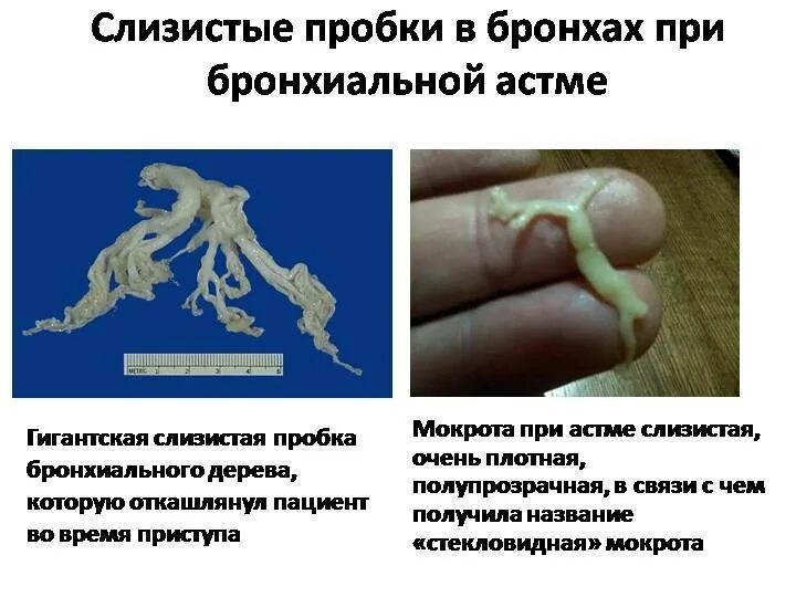 Мокрота астматика. Тип мокроты при бронхиальной астме. слизистая пробка при бронхиальной астме. стекловидная мокрота при бронхиальной астме. цвет мокроты при бронхиальной астме.