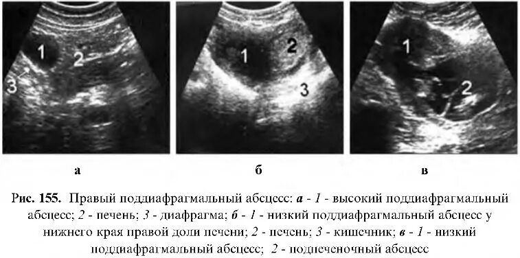 Подпеченочный абсцесс. Межкишечный абсцесс УЗИ. Абсцесс брюшной полости на УЗИ. Внутрибрюшной абсцесс. Абдоминальный абсцесс.